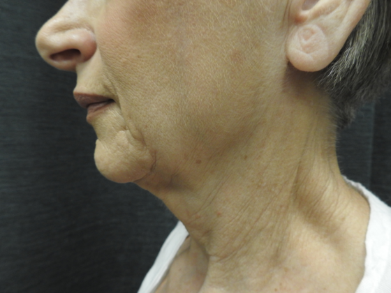 QuickLift: Case 13 - San Antonio - Before