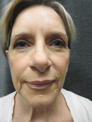 QuickLift: Case 13 - San Antonio - Before