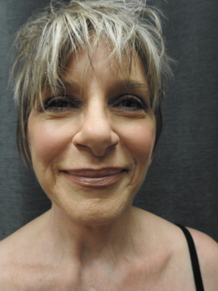 QuickLift: Case 13 - San Antonio - After