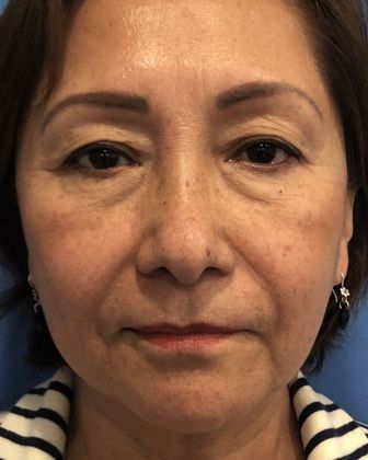 Eyelid Lift: Case 20 Upper Eyelid Lift, Norwalk - Before