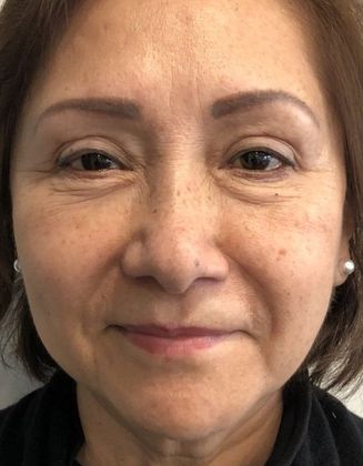 Eyelid Lift: Case 20 Upper Eyelid Lift, Norwalk - After