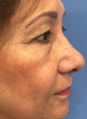 Eyelid Lift: Case 20 Upper Eyelid Lift, Norwalk - Before