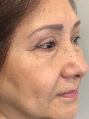 Eyelid Lift: Case 20 Upper Eyelid Lift, Norwalk - After