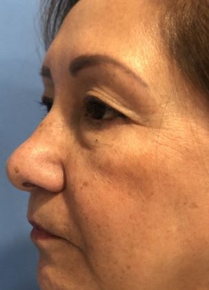 Eyelid Lift: Case 20 Upper Eyelid Lift, Norwalk - Before