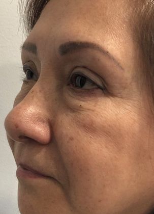 Eyelid Lift: Case 20 Upper Eyelid Lift, Norwalk - After
