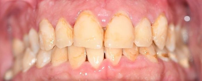 Periodontal Cleaning: Case 4 - Edna, TX - After