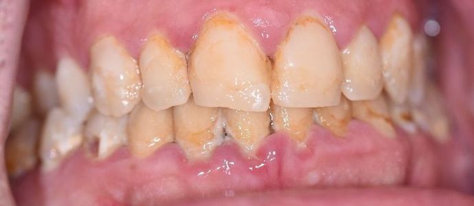 Periodontal Cleaning: Case 4 - Edna, TX - Before