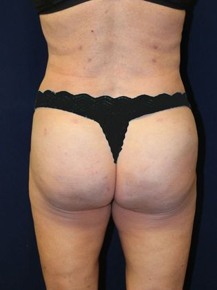 Brazilian Butt Lift : Case 16 - After