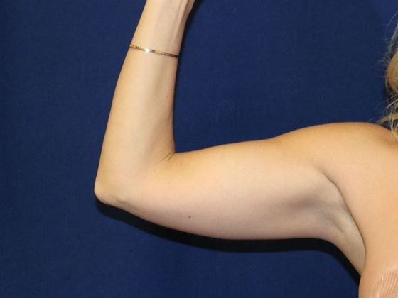 Arm Lift*/Arm Sculpting: Case 7 - Before