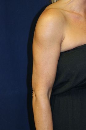 Arm Lift*/Arm Sculpting: Case 7 - After