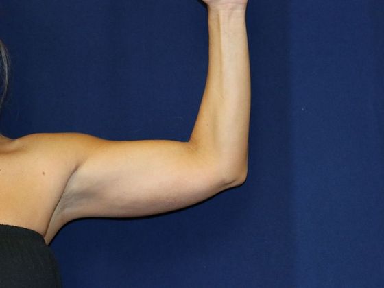 Arm Lift*/Arm Sculpting: Case 7 - After
