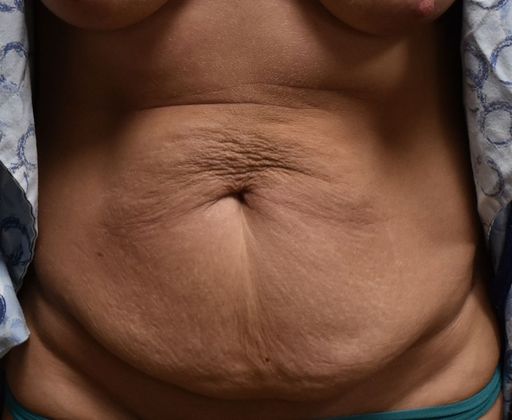 Tummy Tuck (Abdominoplasty): Case 214 - Before