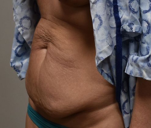 Tummy Tuck (Abdominoplasty): Case 214 - Before