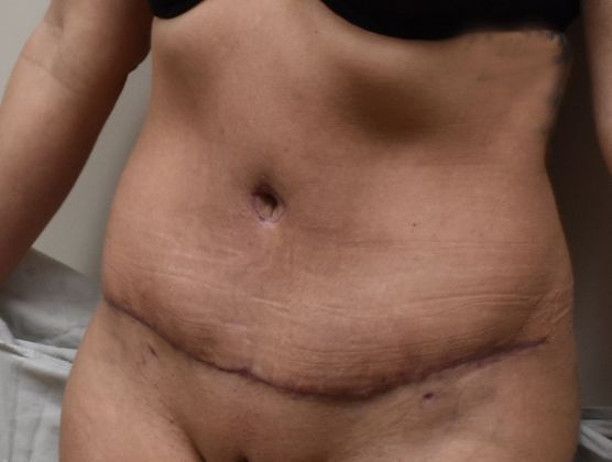 Tummy Tuck (Abdominoplasty): Case 214 - After