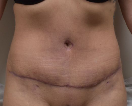 Tummy Tuck (Abdominoplasty): Case 214 - After