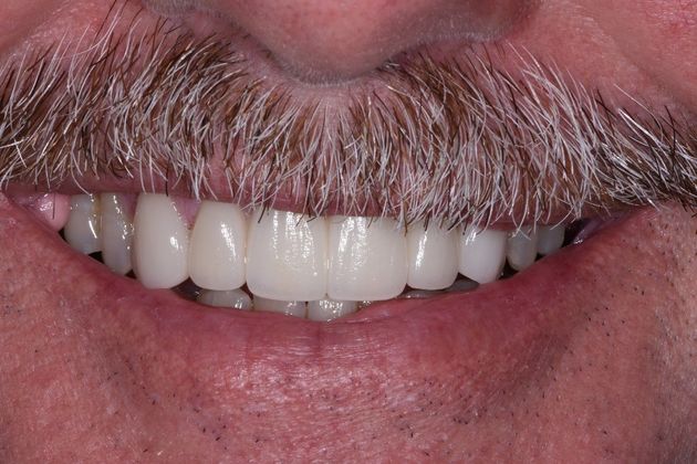 Dental Bridge Case 1 - Lake Jackson, TX - After