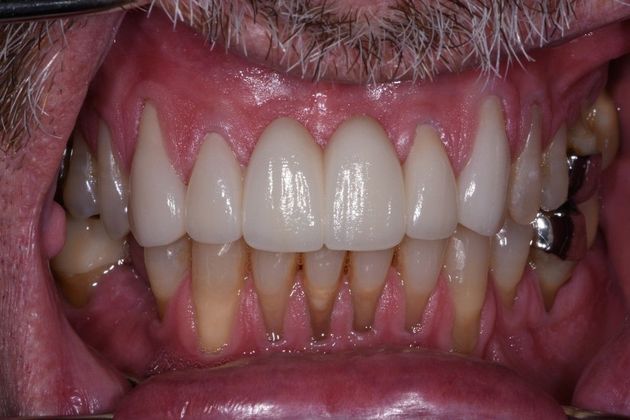 Dental Bridge: Case 1 - Lake Jackson, TX - After