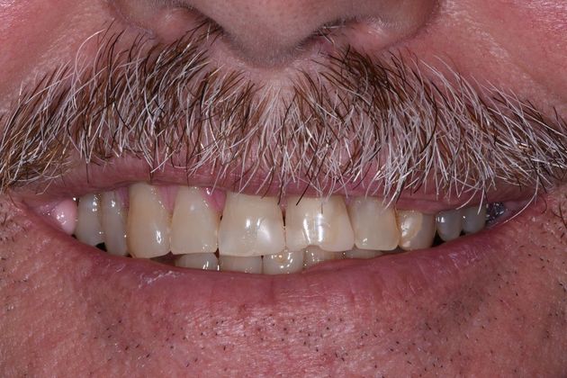 Dental Bridge Case 1 - Lake Jackson, TX - Before