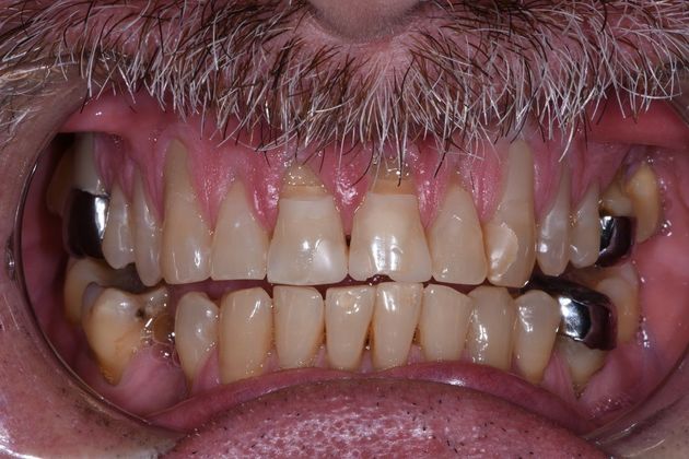 Dental Bridge: Case 1 - Lake Jackson, TX - Before