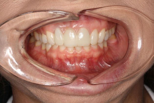 Dental Bridge: Case 2 - West Columbia, TX - After