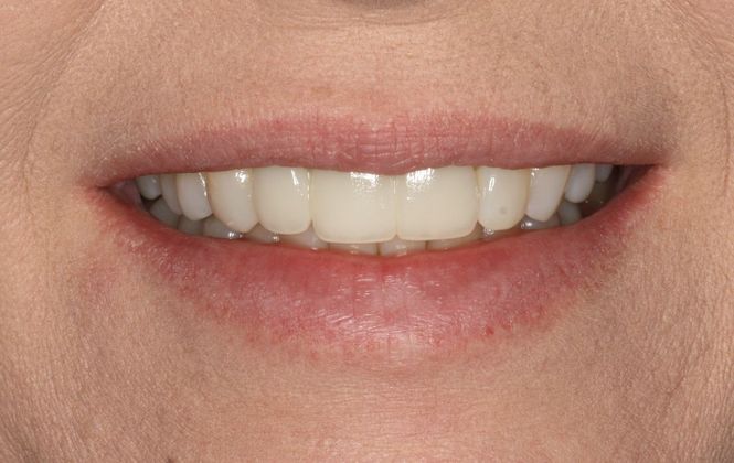 Dental Bridge: Case 2 - West Columbia, TX - After