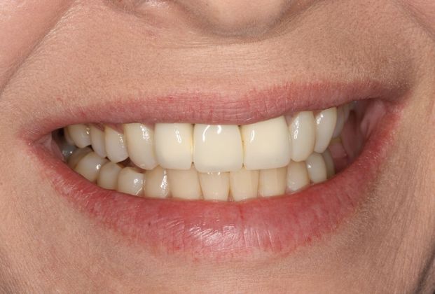 Dental Bridge: Case 2 - West Columbia, TX - Before