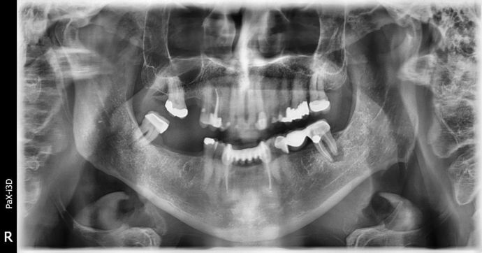 Dental Implants: Case 2 - Sweeny - Before