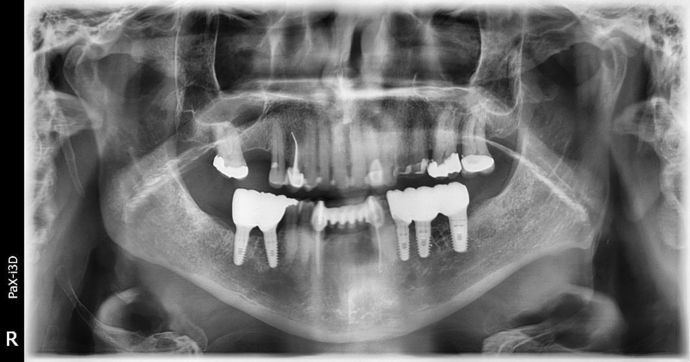 Dental Implants: Case 2 - Sweeny - After