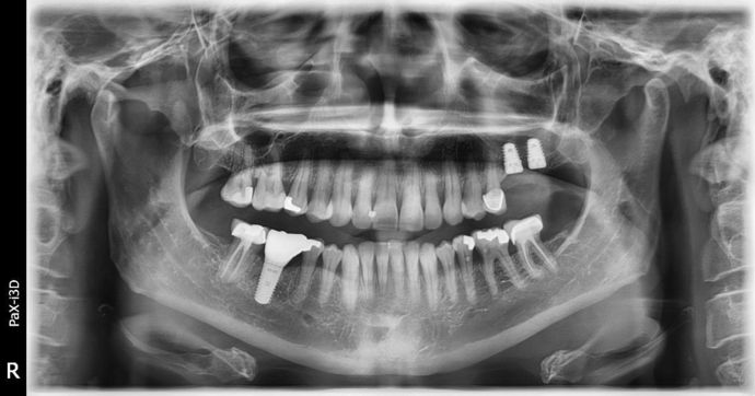 Dental Implants: Case 3 - Freeport - Before