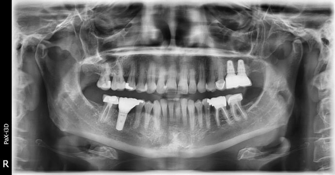 Dental Implants: Case 3 - Freeport - After