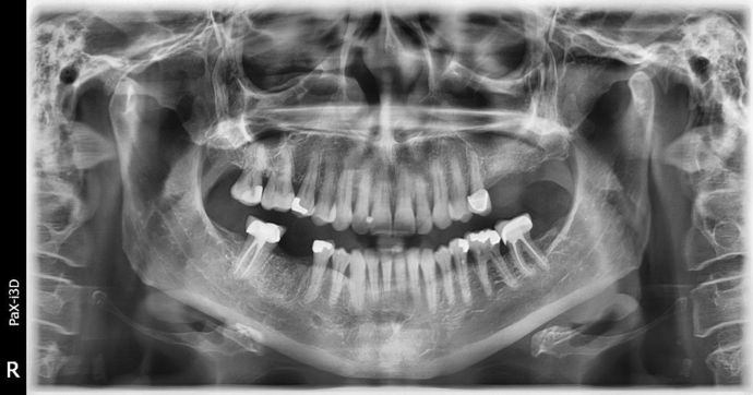 Dental Implants: Case 3 - Freeport - Before