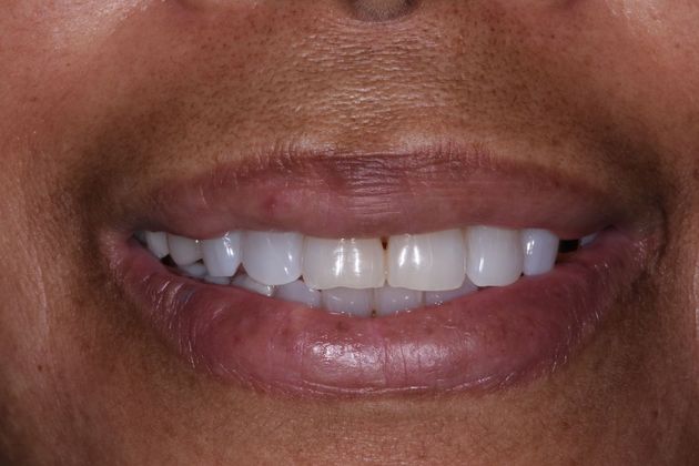 Cosmetic Dentistry Case 1 - Richwood - Before