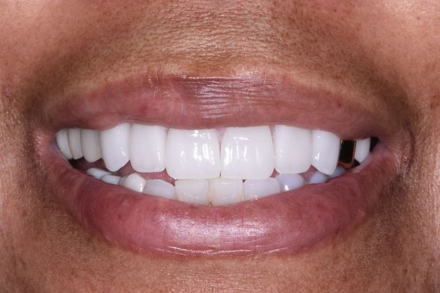 Cosmetic Dentistry Case 1 - Richwood - After