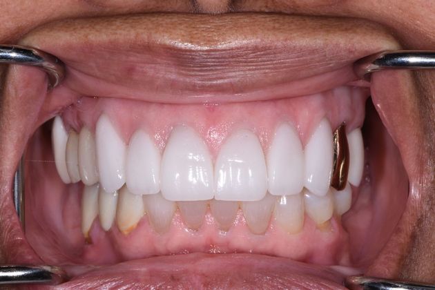 Cosmetic Dentistry: Case 1 - Richwood - After