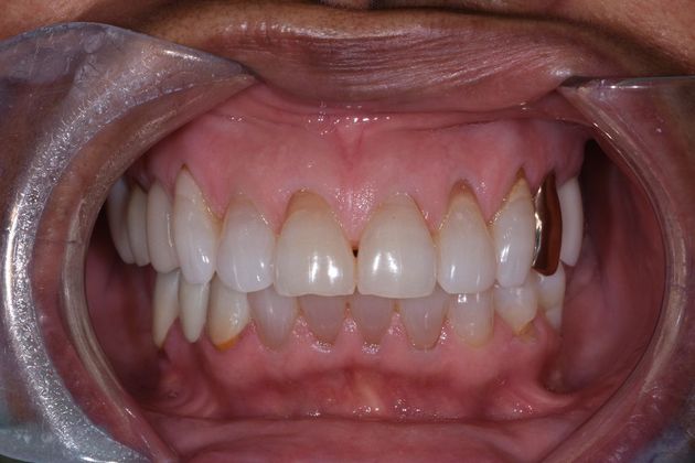 Cosmetic Dentistry: Case 1 - Richwood - Before