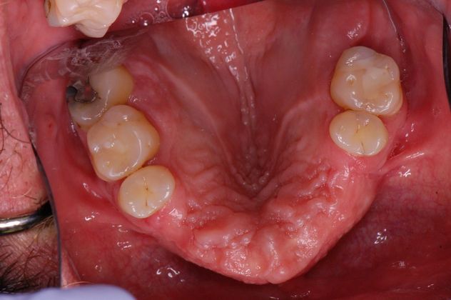 Dental Implants: Case 5 - Before