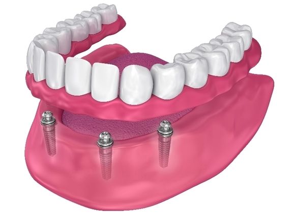 Implant Dentures Case