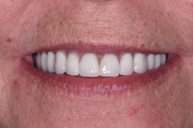 Implant Dentures: Case 1 - Sargent - After