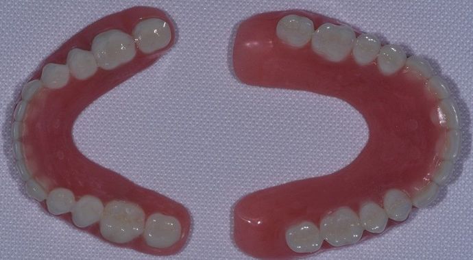 Implant Dentures: Case 1 - Sargent - Dentures teeth