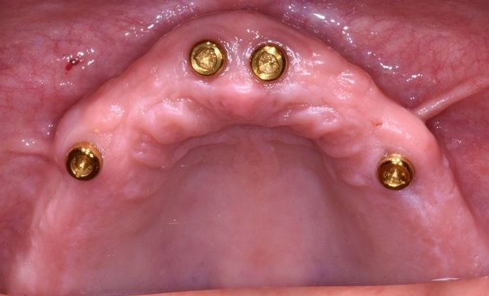 Implant Dentures: Case 1 - Sargent - Upper jaw