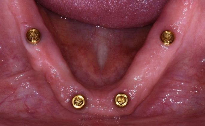 Implant Dentures: Case 1 - Sargent - Lower jaw
