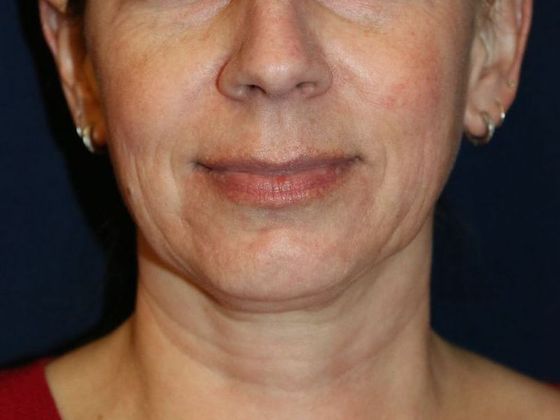 PDO Threads Case 2 - Before