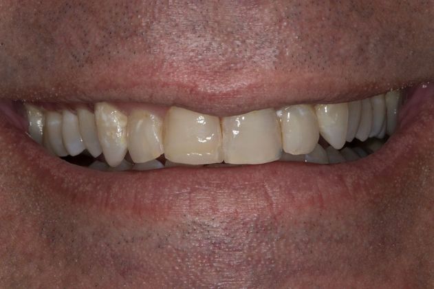 Dental Crowns: Case 1 - Before