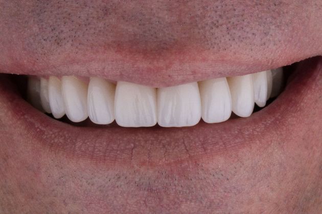 Dental Crowns: Case 1 - After