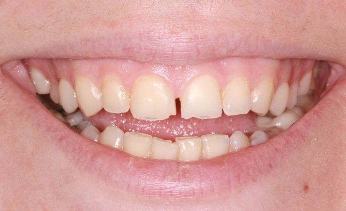 Full Mouth Makeovers: Case 1 - Before