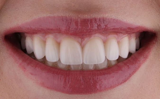 Full Mouth Makeovers: Case 1 - After