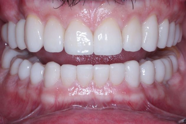 Full Mouth Makeovers: Case 2 - Before