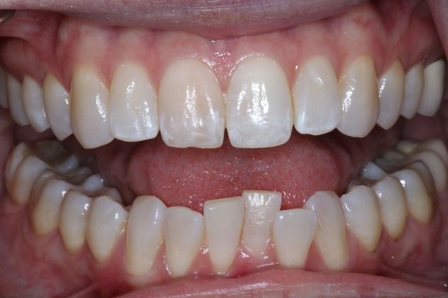 Orthodontics Case 1 - Before