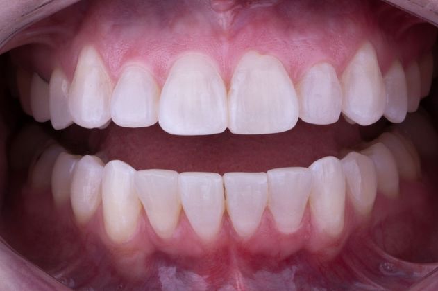 Orthodontics Case 2 - After