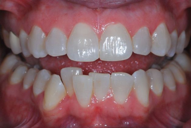 Orthodontics Case 2 - Before